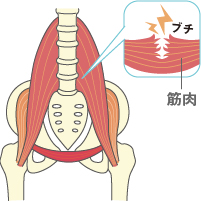 ぎっくり腰